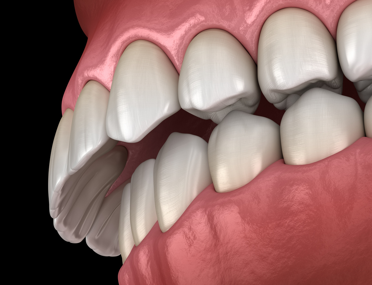 Overbite dental occlusion ( Malocclusion of teeth ). Medically accurate tooth 3D illustration