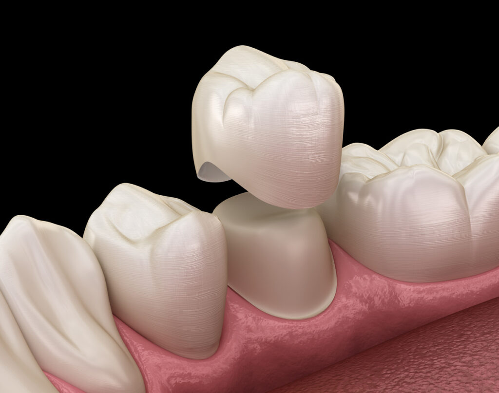 Dental crown premolar tooth assembly process. Medically accurate