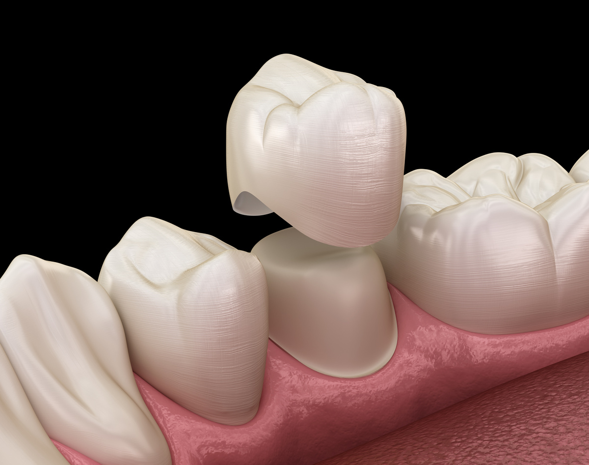Dental crown premolar tooth assembly process. Medically accurate