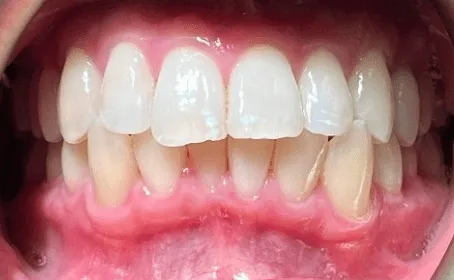 Invisalign before treatment - patient case 1