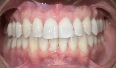 Invisalign after treatment - patient case 1