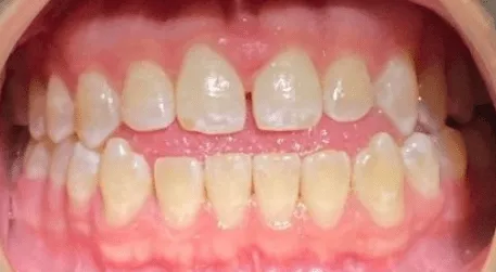 Invisalign before treatment - patient case 2