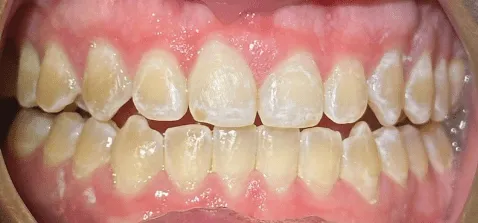 Invisalign after treatment - patient case 2