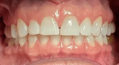 Invisalign before treatment - patient case 3