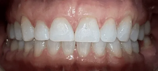 Invisalign after treatment - patient case 3