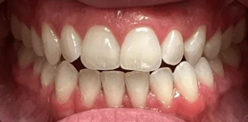 Invisalign before treatment - patient case 4