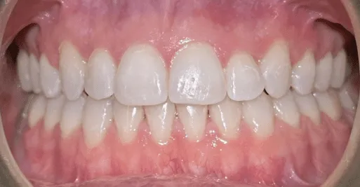 Invisalign after treatment - patient case 4