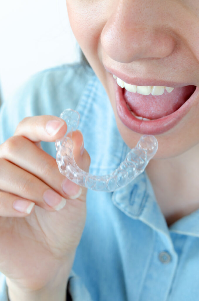 Boca de mujer con placa alineadora para tratamiento de ortodoncia invisible. Plano picado.