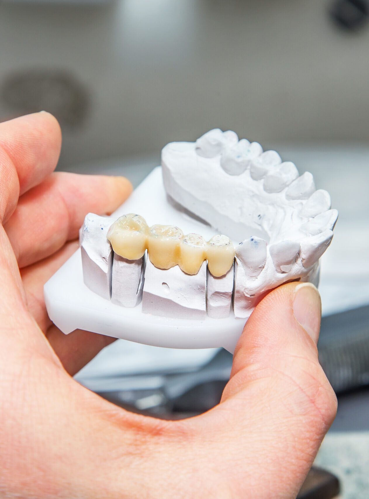 Technical shots of model on a dental prothetic laboratory.Dentist hand with plaster model and ceramic dentures