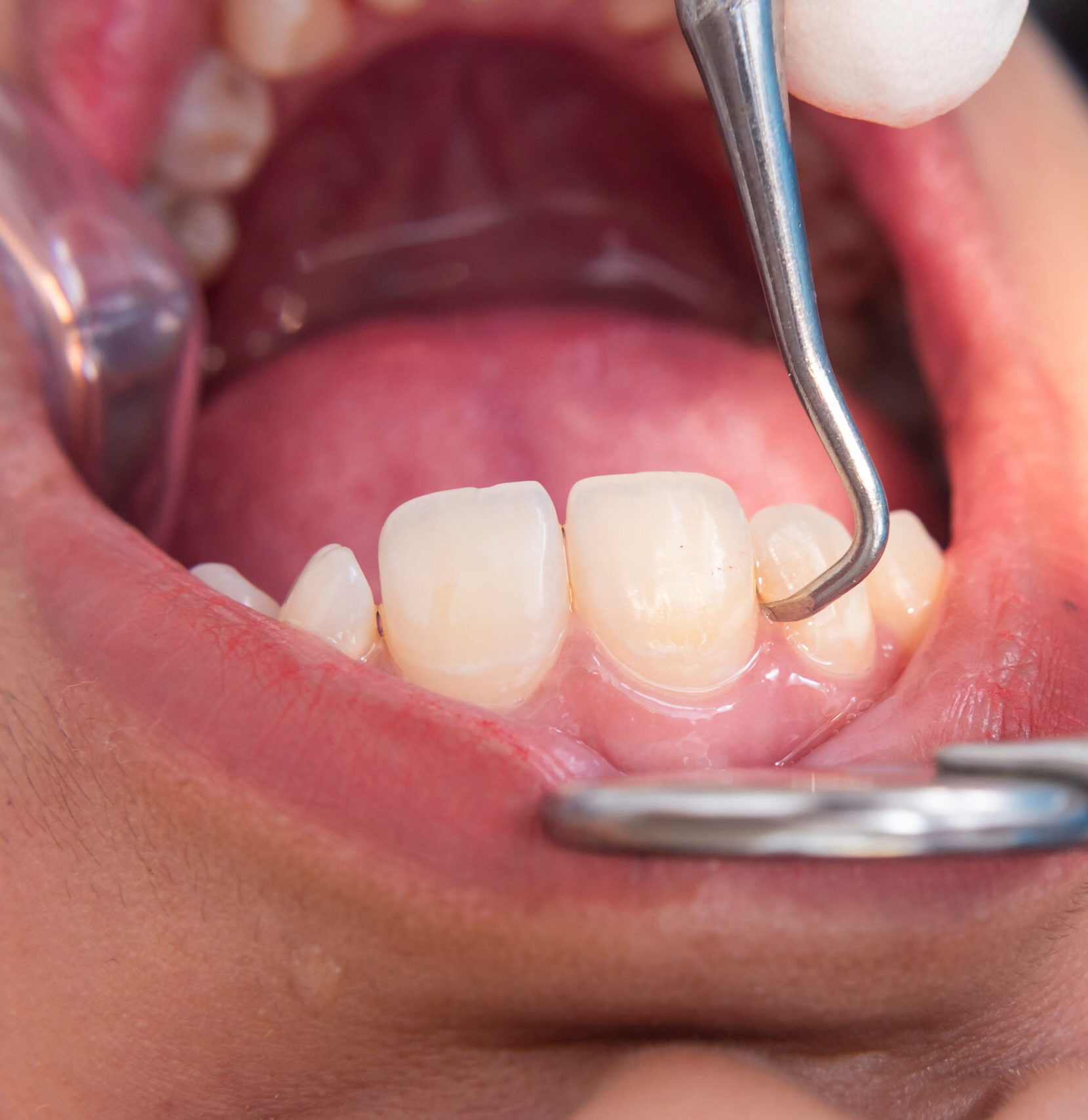 Macro image of dental scaling on lower anterior teeth using a metal scaler to remove plaque and calculus near the gum line.