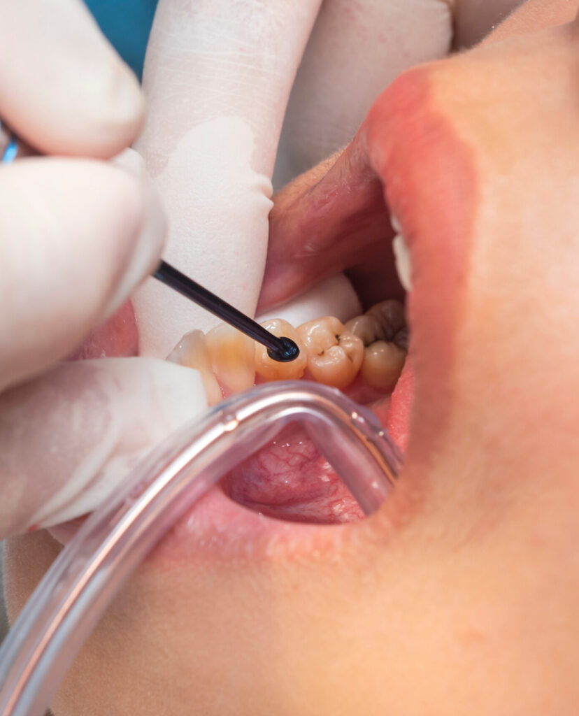 Macro view of dental professional inserting composite into a lower premolar cavity using a delivery tip during filling procedure.
