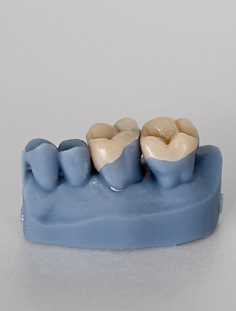 Close-up of blue dental cast showing tooth inlays and onlays. Concept of dental prosthetics, cavity treatment, and precision lab work in restorative dentistry.