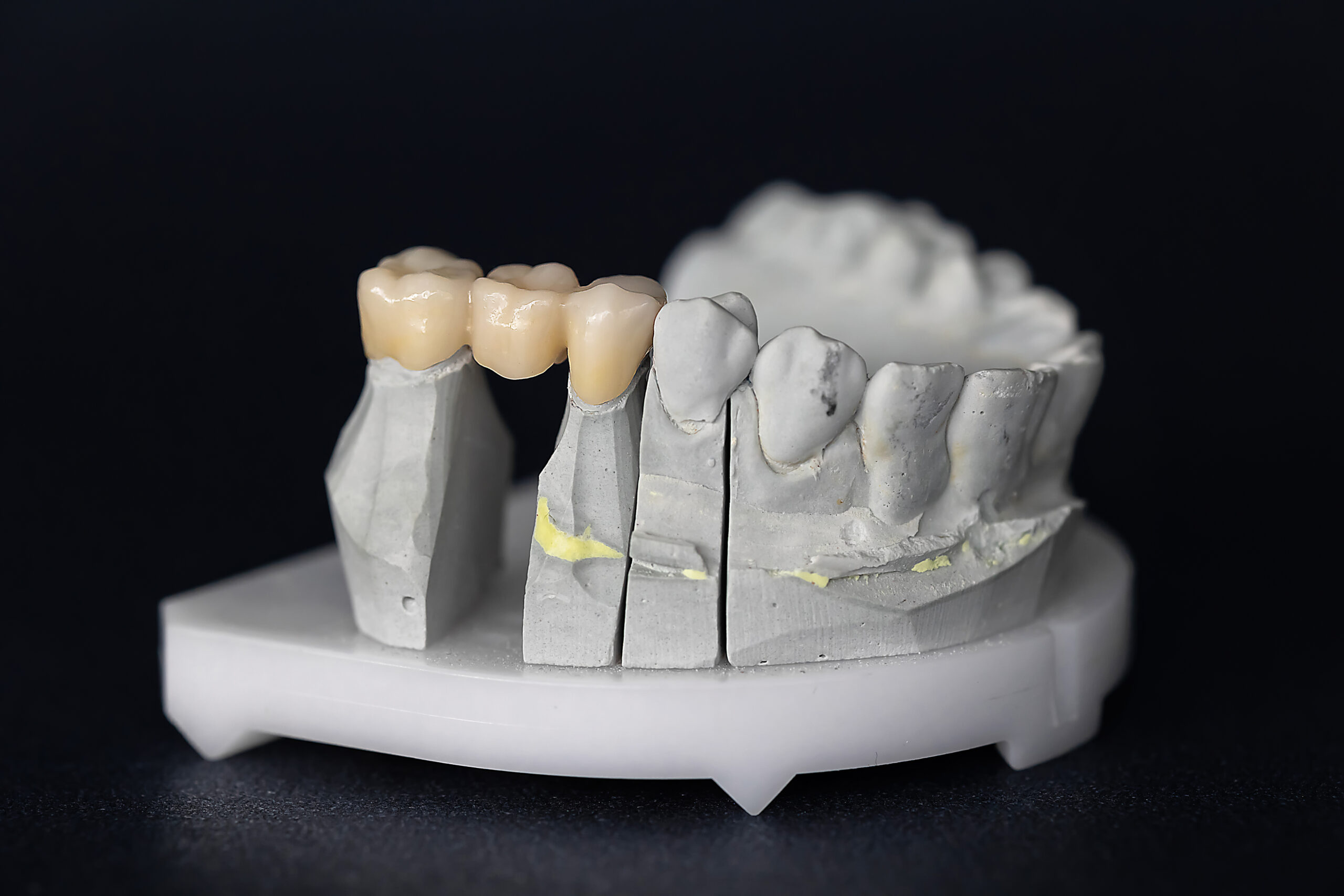 Close-up of gypsum dental model with zirconia bridge on teeth 5 to 7. Concept of fixed prosthetics, dental bridges, and modern restorative dentistry.