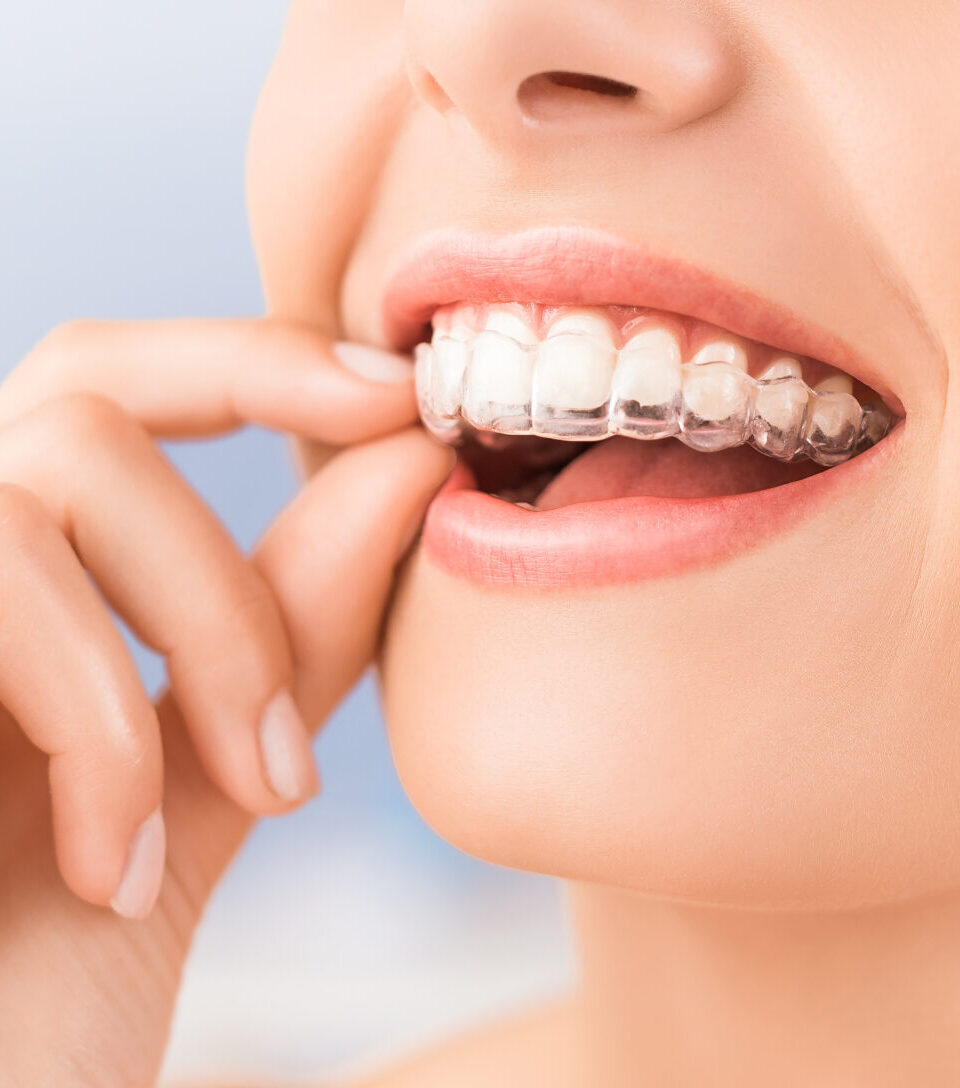 Woman wearing orthodontic silicone trainer. Invisible braces aligner. Mobile orthodontic appliance for dental correction.