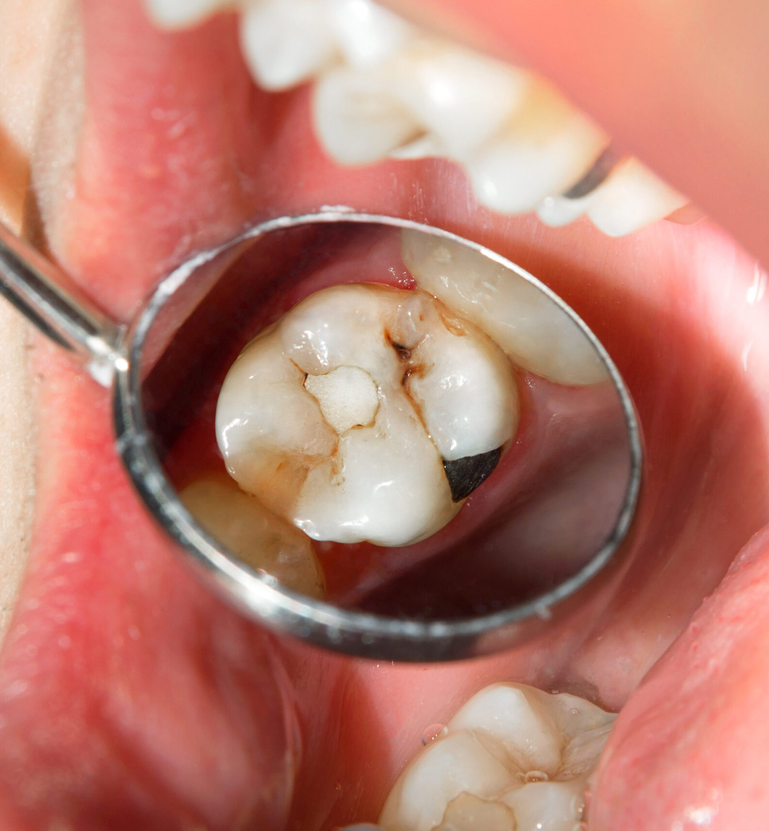 close-up of a human rotten carious tooth at the treatment stage in a dental clinic. The use of rubber dam system with latex scarves and metal clips, production of photopolymeric composite fillings