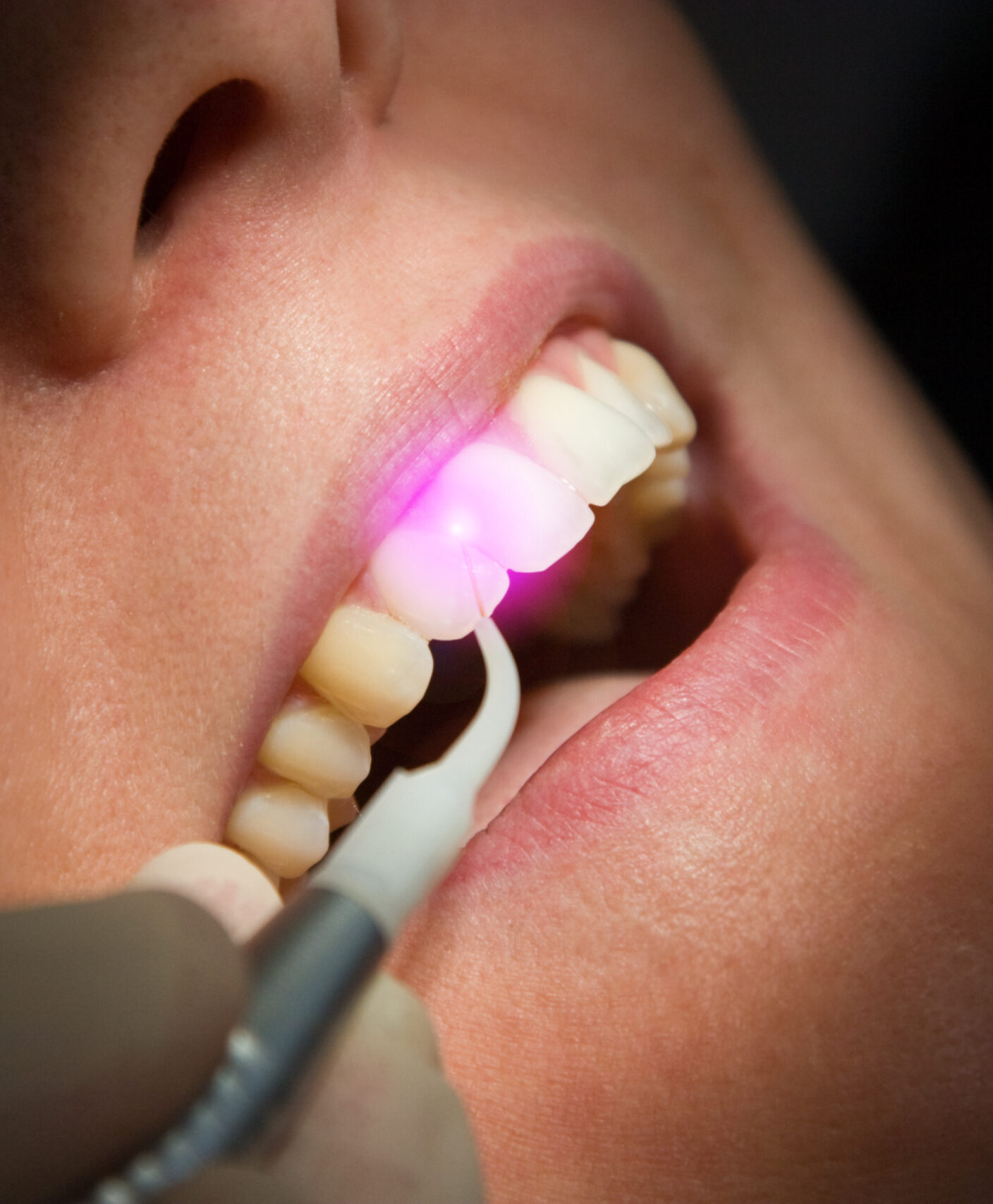 Dental Laser Zahnbehandlung Zahnfleisch