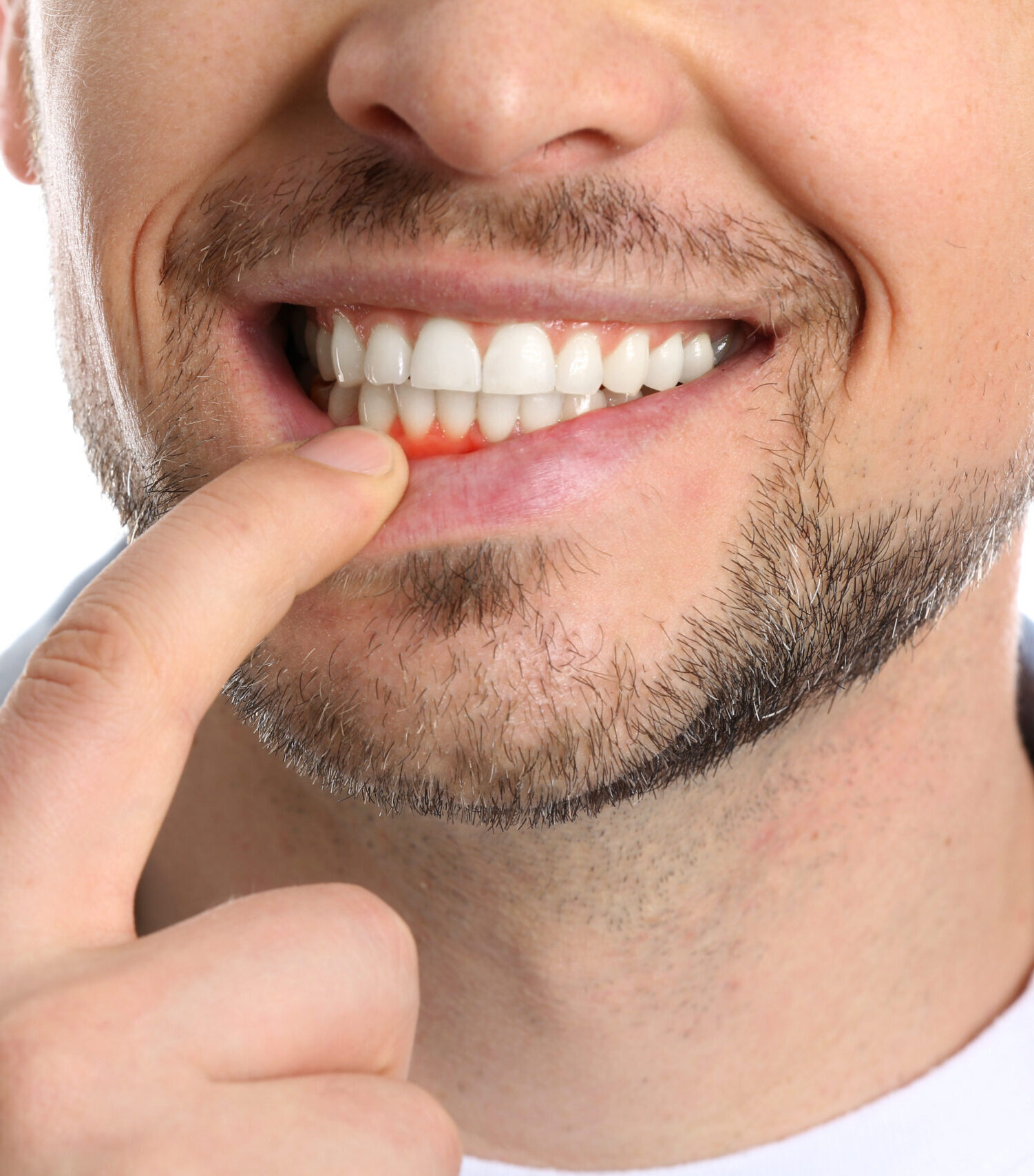 Man with gum inflammation on white background, closeup