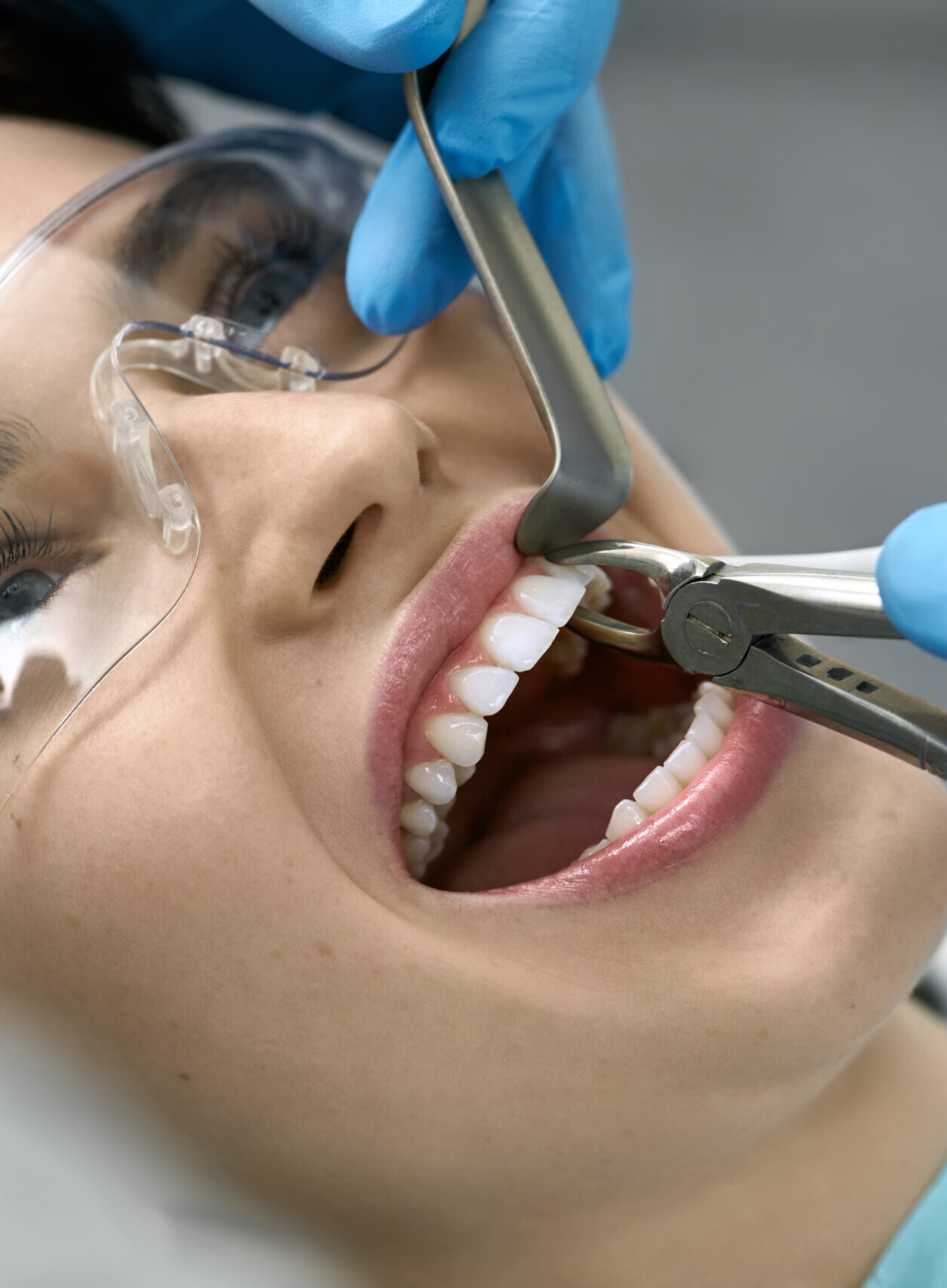 Poor girl in a patient's bib and protective glasses in a dental clinic. Dentist in blue latex gloves is removing her tooth with a help of a cheek retractor and forceps. Closeup horizontal photo.
