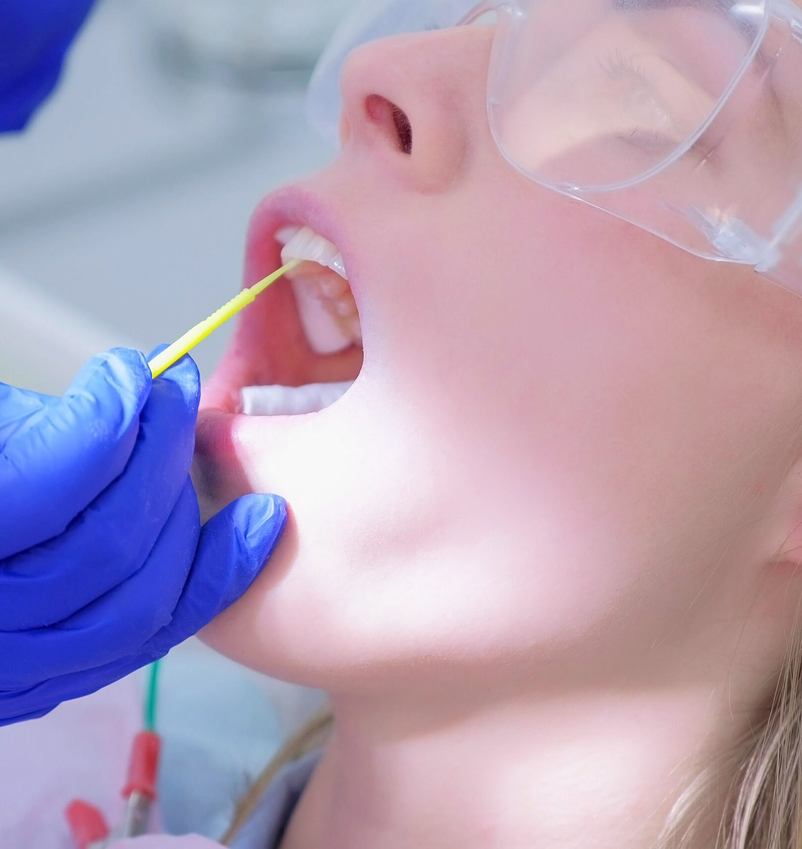 Dentist make fluoridation of teeth after ultrasonic cleaning for young woman. Stomatologist apply fluoride on patient's teeth. Portrait of young woman. Stomatology clinic, cure, treatment, procedure.
