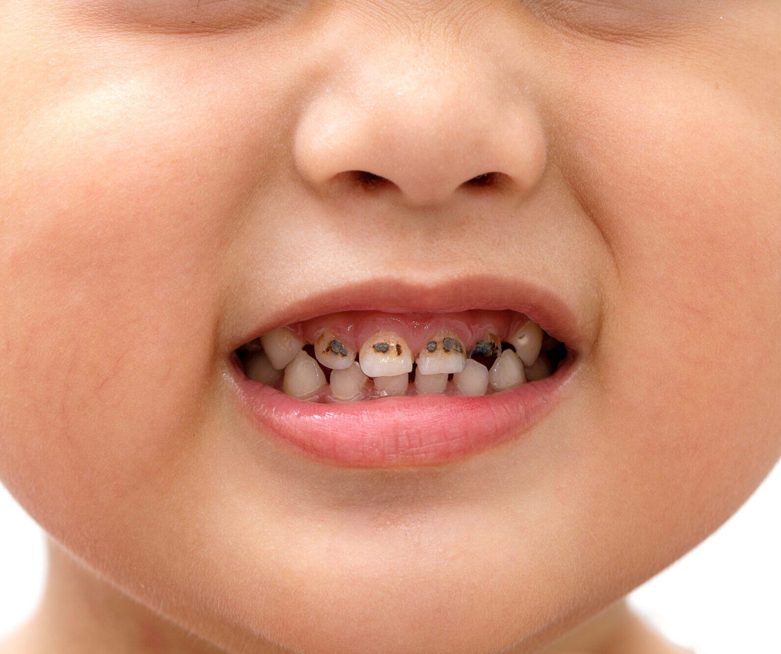 Tooth decay of children who like to eat sweets candy. And doesn't like brushing teeth