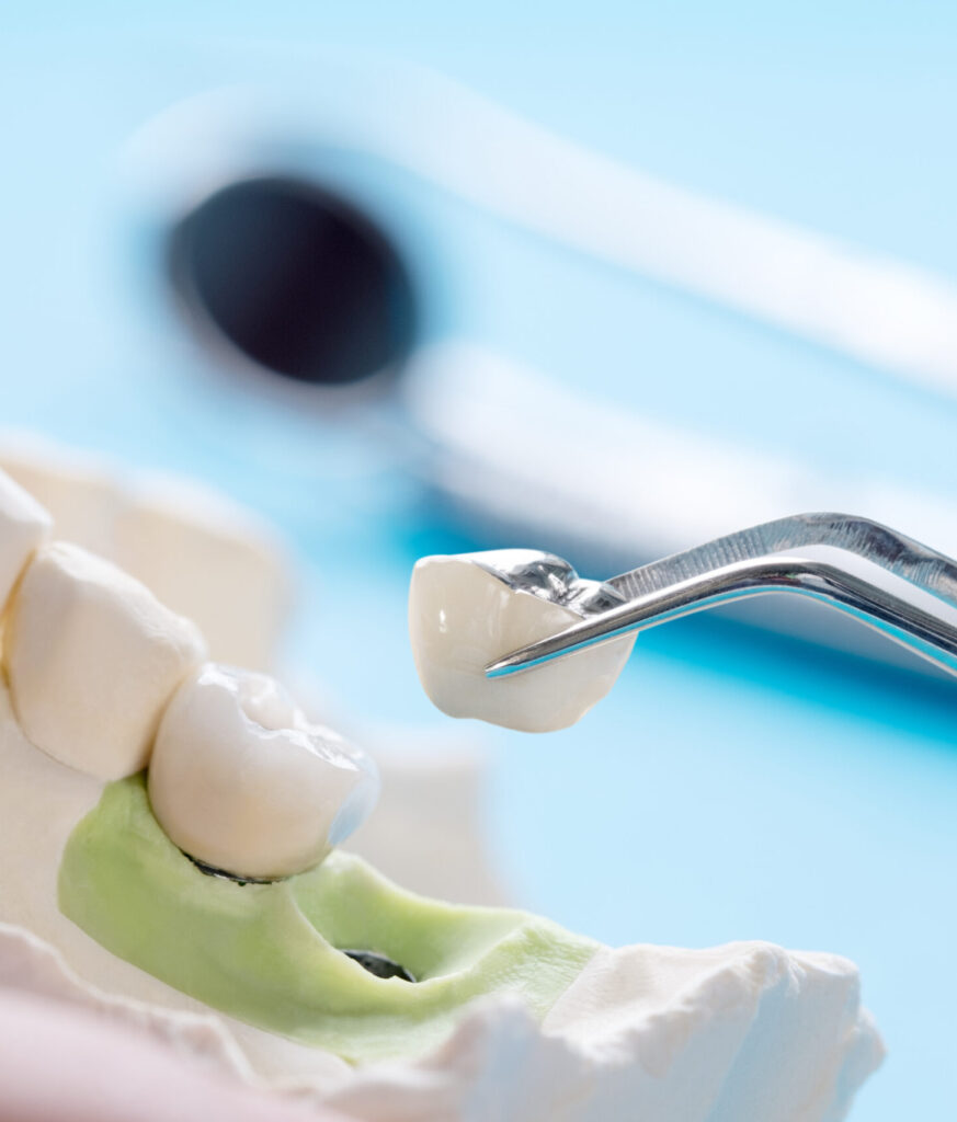 Close up Implan model tooth support fix bridge implan and crown.