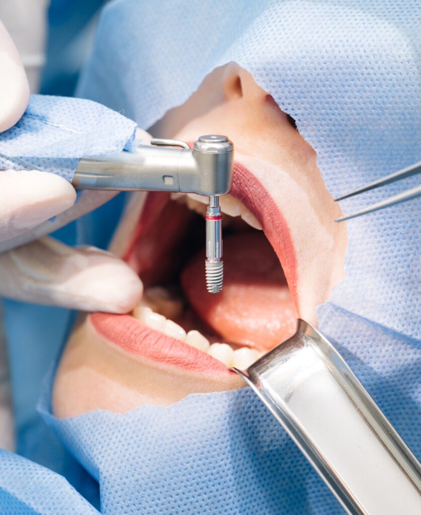 Close-up shot of attentive doctors performing surgical operation installing dental implants into patient's mouth in modern dental clinic. Dental instruments. Stomatology clinic. Dental surgery.