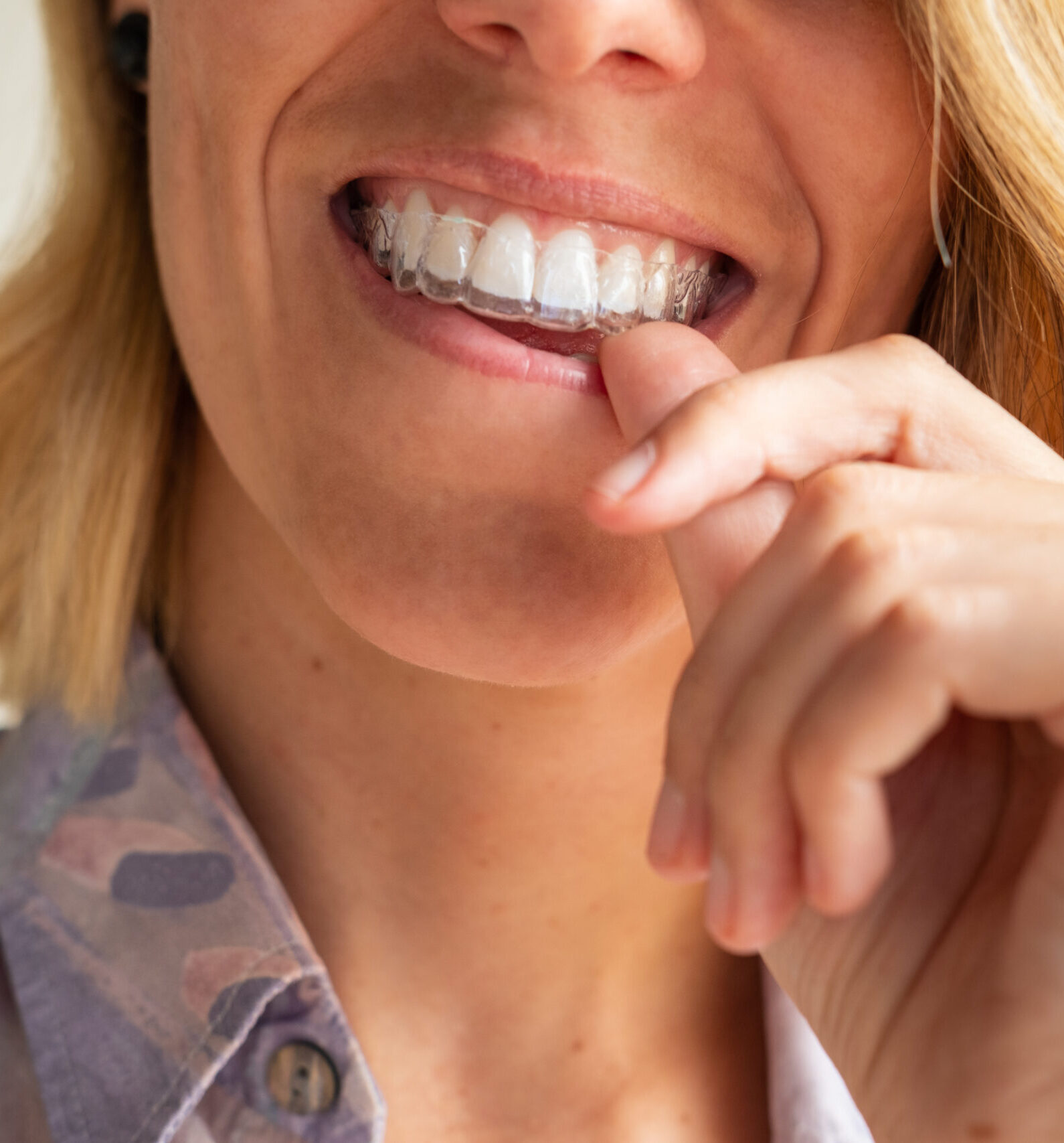Beautiful smile and white teeth of a young blonde woman with invisible braces