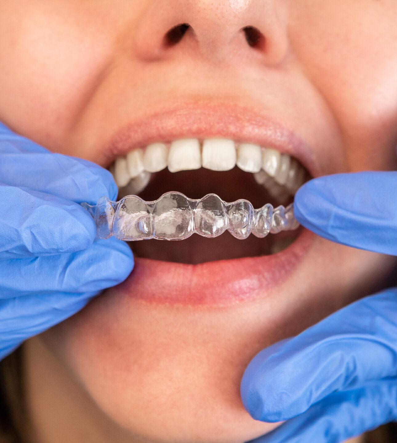 Dentist in gloves applying invisible aligner on female patient teeth at modern clinic. Orthodontic removable straighteners in dentist office. Dental treatment concept.