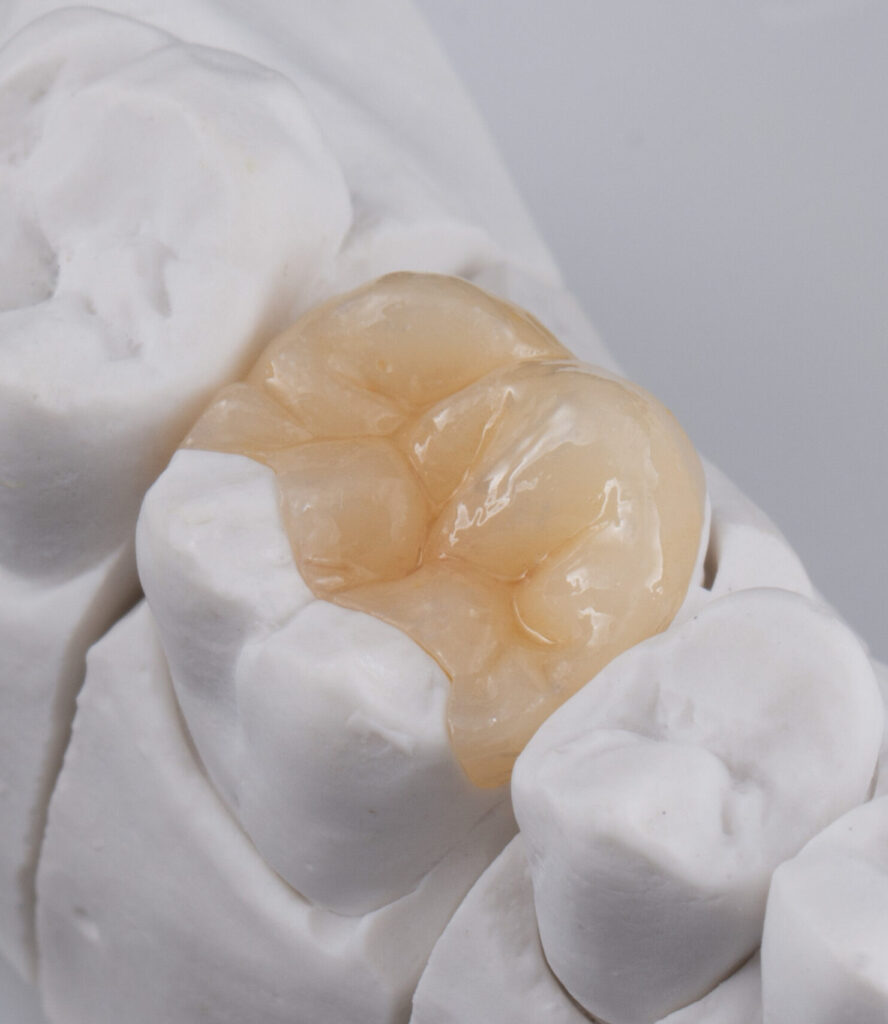 Dental ceramic Inlay