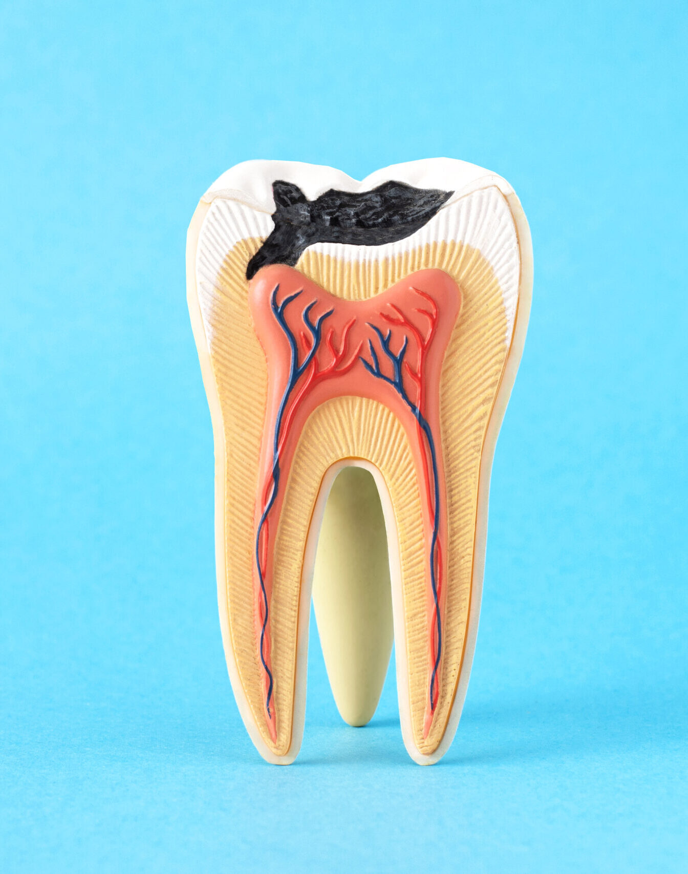Close-up internal tooth structure model with fisrt step of caries decay on blue background