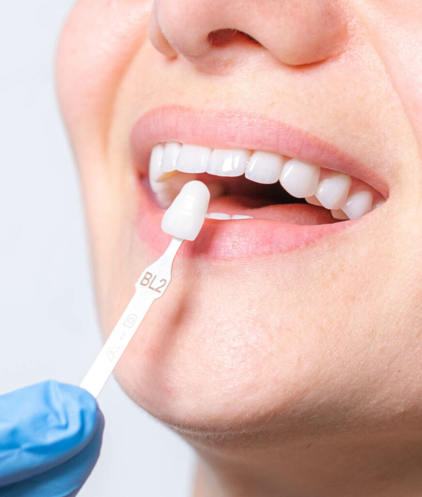 Banner tooth whitening, perfect white teeth close up with shade guide bleach color, female veneer smile, dental care and stomatology, dentistry, copyspace.