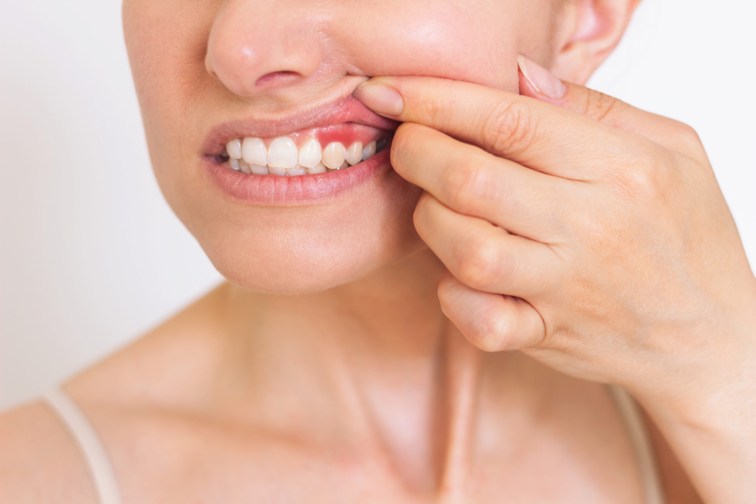 a close-up photo of a young Caucasian woman who shows off her red gums on the upper jaw, suffers from gum inflammation. Dental care. Dentistry