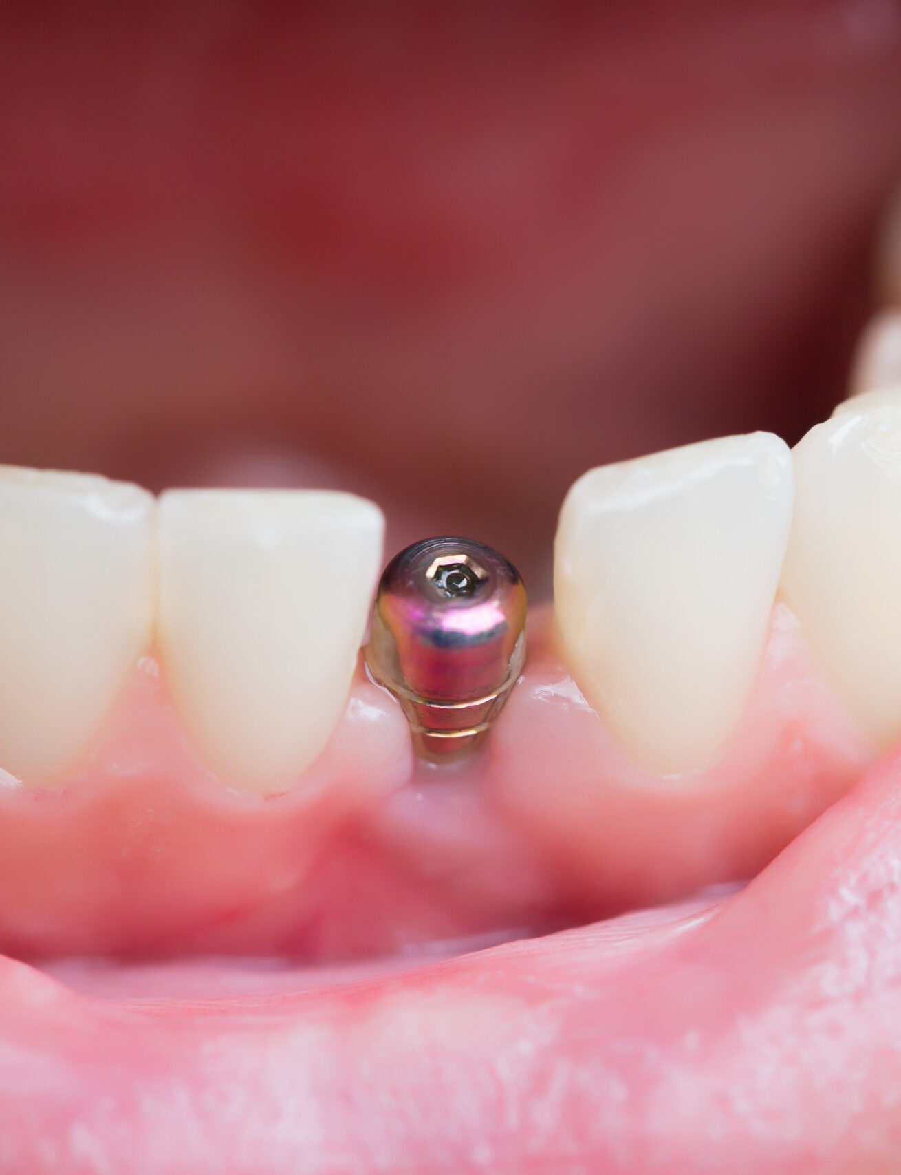 single tooth implant