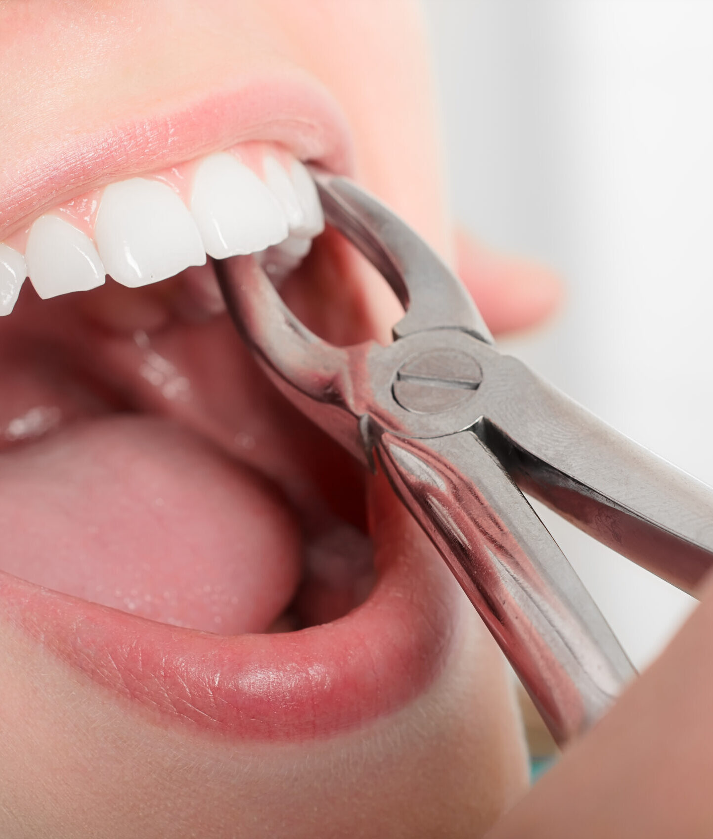 Removing the sick tooth from girls mouth