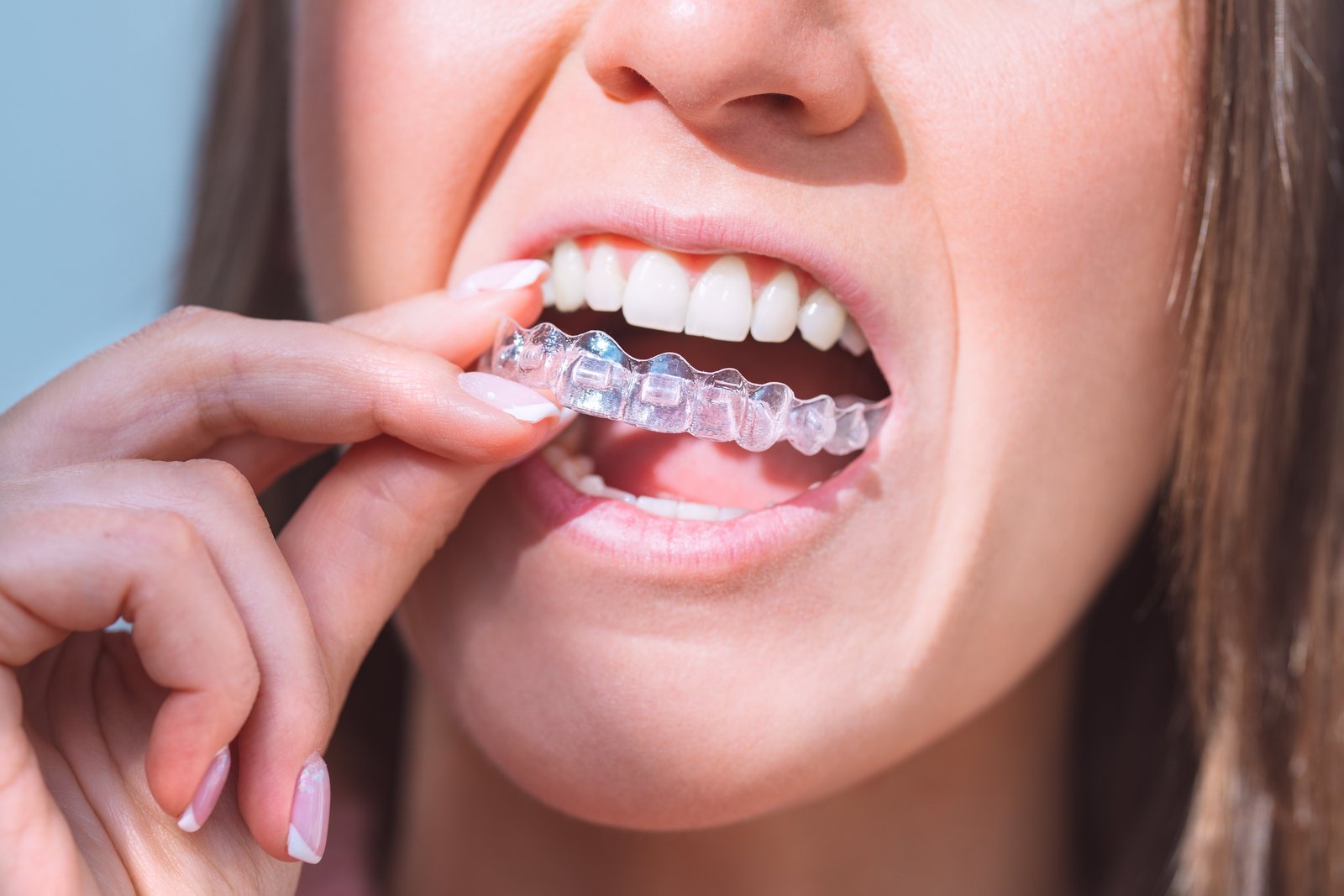 Woman inserting clear Invisalign aligner tray for dental correction
